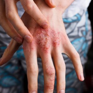 Ατοπική Δερματίτιδα - Ξηροδερμία